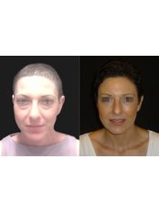 Eyelid surgery - Opsis Clinical - Athens