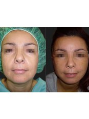 Mid Facelift - Opsis Clinical - Athens