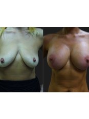 Breast Lift - Opsis Clinical - Athens