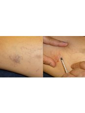 Spider Veins Treatment - Opsis Clinical - Athens