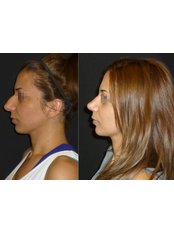 Rhinoplasty - Opsis Clinical - Athens