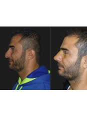 Rhinoplasty - Opsis Clinical - Athens