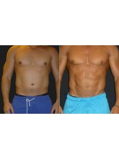 Liposuction - Opsis Clinical - Athens