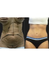 Abdominoplasty - Opsis Clinical - Athens