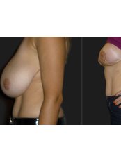 Breast Reduction - Opsis Clinical - Athens
