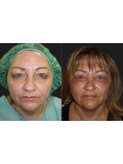 Mid Facelift - Opsis Clinical - Athens