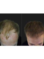 Hair Transplant - Opsis Clinical - Athens