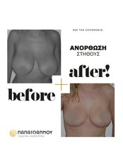 Breast Lift - Papaioannou Plastic Surgery - Athens