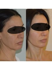 Facelift - Papaioannou Plastic Surgery - Athens