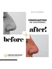 Rhinoplasty - Papaioannou Plastic Surgery - Athens