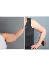 Arm Lift - Dr.Stam Plastic Surgery