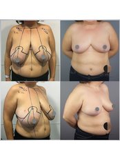 Breast Reduction - Dr.Stam Plastic Surgery