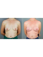 Breast Reconstruction - Dr.Stam Plastic Surgery