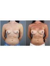 Breast Implants - Breast Augmentation - Dr.Stam Plastic Surgery