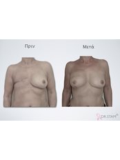 Breast Reconstruction - DIEP Flap - Dr.Stam Plastic Surgery