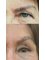 Budapest Cosmetic Surgery Clinic - eyelid lift + eyebrow lift 