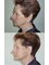 Budapest Cosmetic Surgery Clinic - Facelift + neck lift before after 4 moths 