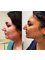 Budapest Cosmetic Surgery Clinic - Dr Rodrigo Buccal Fat removal , chin liposuction 