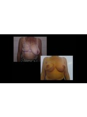 Breast Reconstruction - Imago Plastic Surgery
