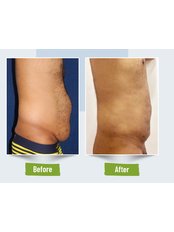 Liposuction - Célèbre Aesthetics - Ahmedabad