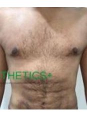 Liposuction - Aestheticsplus Clinic  Rajajinagar