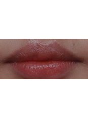 Cleft Lip and Palate Treatment - Aestheticsplus Clinic  Rajajinagar