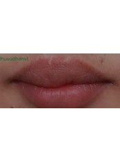Cleft Lip and Palate Treatment - Aestheticsplus Clinic  Rajajinagar