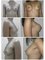 Cosmoglitz Cosmetic Centre - Breast Implant - Pre and Post Photos 