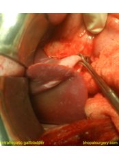 Gallbladder Removal - Bhopal Surgery