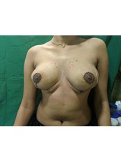 Breast Reduction - MMRV HOSPITAL
