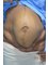 ROYS COSMETICSURGERY CENTRE - Pendulous abdomen before Tummy tuck 1. 