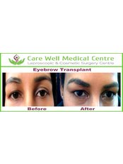 Eyebrow Transplant - Care Well Medical Centre