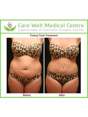 Tummy Tuck - Care Well Medical Centre