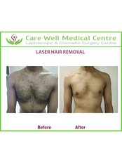 Laser Hair Removal - Care Well Medical Centre