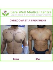 Gynecomastia - Care Well Medical Centre