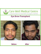 Eyebrow Transplant - Care Well Medical Centre