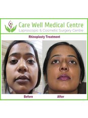 Rhinoplasty - Care Well Medical Centre