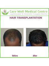 Hair Transplant - Care Well Medical Centre