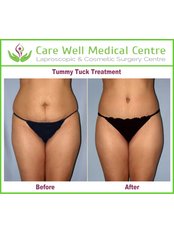 Tummy Tuck - Care Well Medical Centre