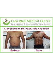 Liposuction - Care Well Medical Centre