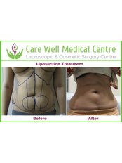 Liposuction - Care Well Medical Centre
