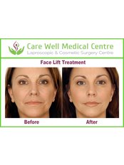 Facelift - Care Well Medical Centre