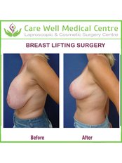 Breast Lift - Care Well Medical Centre