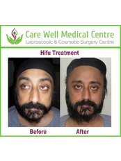 HIFU - High-Intensity Focused Ultrasound - Care Well Medical Centre