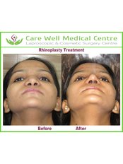 Rhinoplasty - Care Well Medical Centre