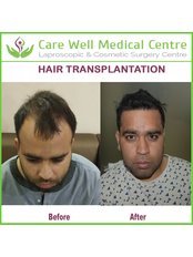 Hair Transplant - Care Well Medical Centre