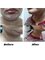 Dr. Rohit Krishna - Liposuction of the neck 