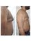 Kalosa - Hair & Cosmetic Clinic - male breast reduction  