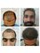Kalosa - Hair & Cosmetic Clinic - pre and post , mega session hair transplant  