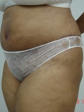 Mini Abdominoplasty - Ambrosia Clinic